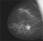 La mamografia digital redueix els resultats falsos positius en la detecció precoç de càncer de mama