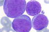 Epigenética en linfomas y leucemias